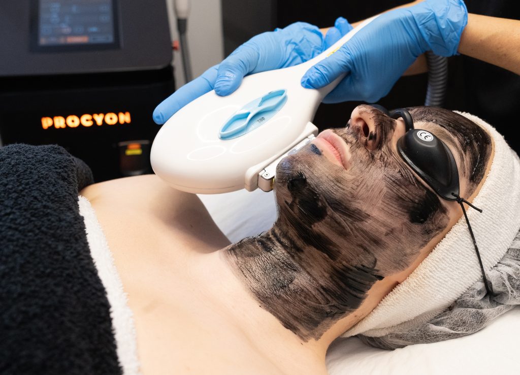 Aplicación de Carbon Peel con láser en cabina de estética avanzada.